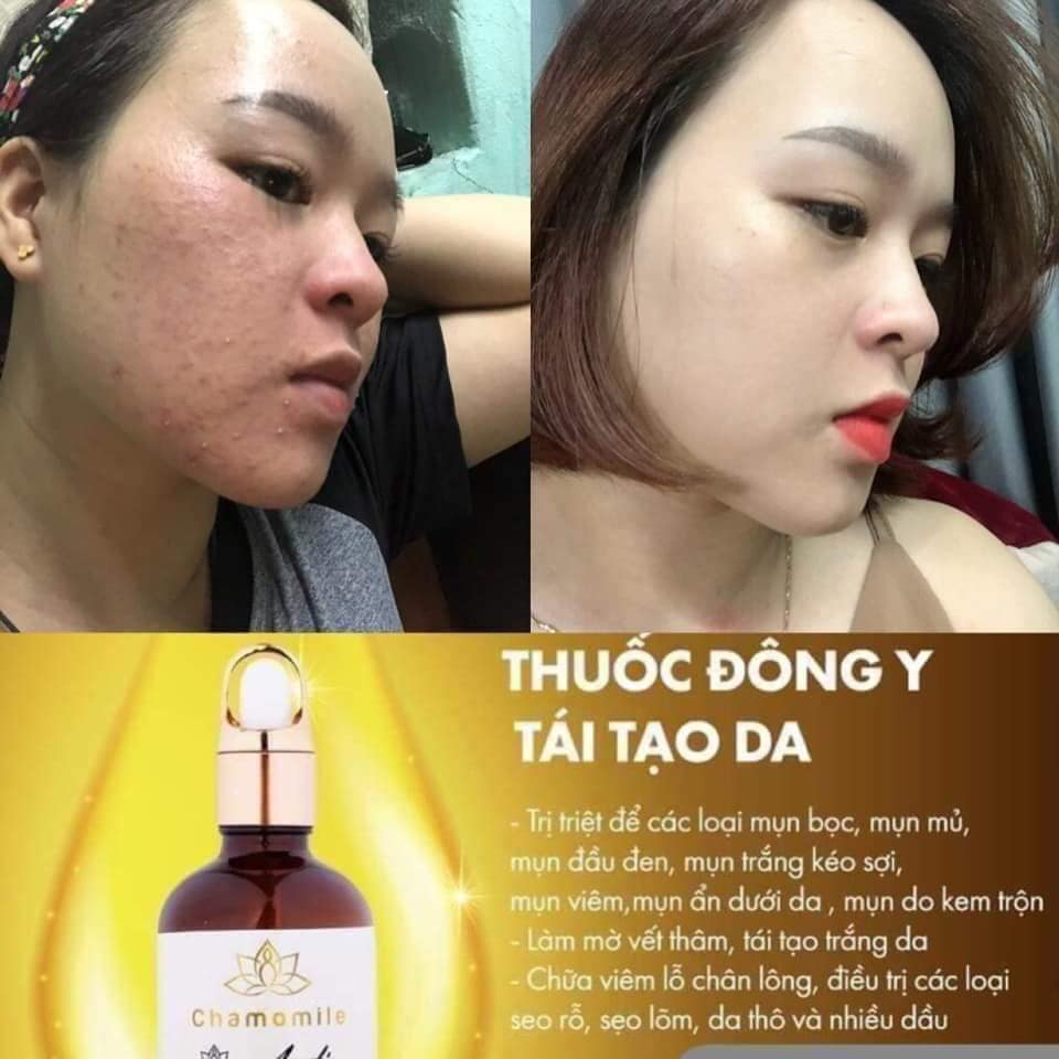 Thuốc trị mụn đông y Chamomile